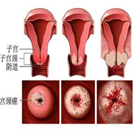 常造成子宫肥大的病因有哪些