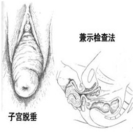 什么叫子宫脱垂