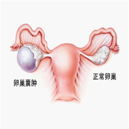 当心卵巢囊肿的蛛丝马迹
