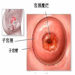 宫颈糜烂的原因有哪些
